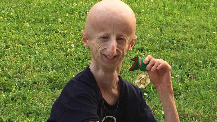 Sammy Basso ha testato il farmaco per la progeria